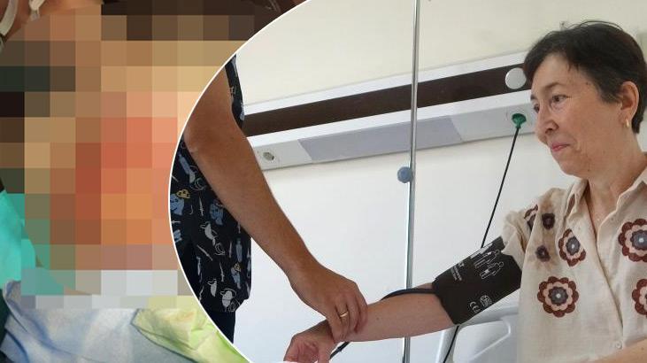 Göğsünde siyahlık başladı, umursamadı! Karpuz kadar büyüyünce patladı