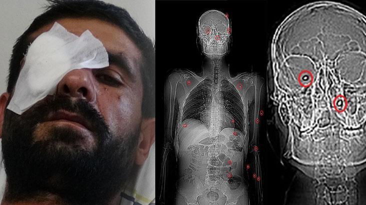 4 kişi pusu kurdu kurşun yağdırdı! 20 gündür saçmalarla yaşıyorum