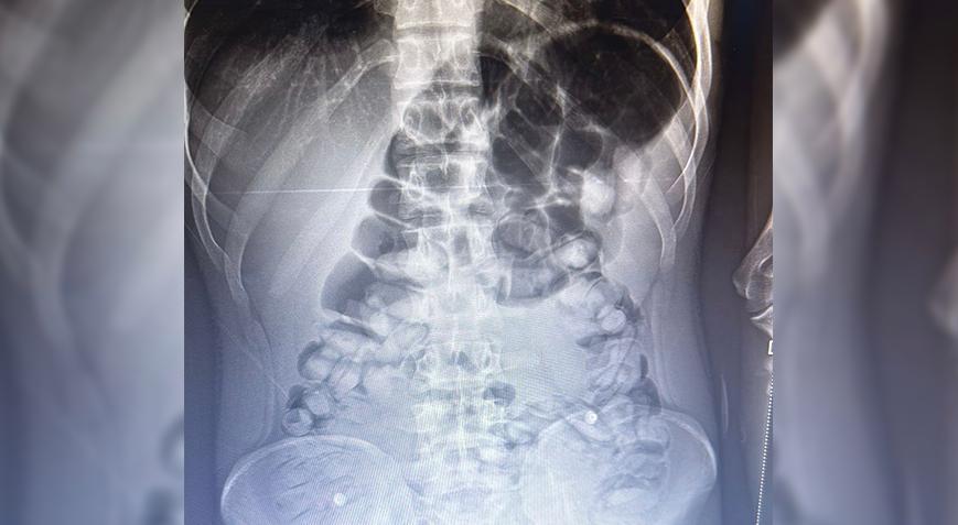 Midesinden 1 kilo 134 gram Afyon sakızı çıktı
