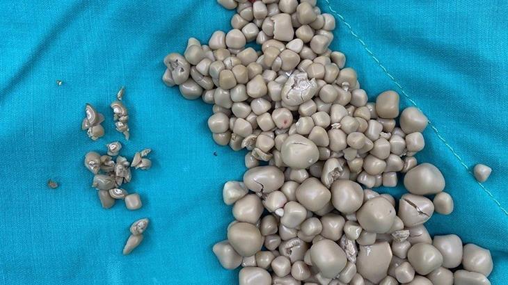 Tayvan’da bir kadının böbreklerinden 300 taş çıkarıldı