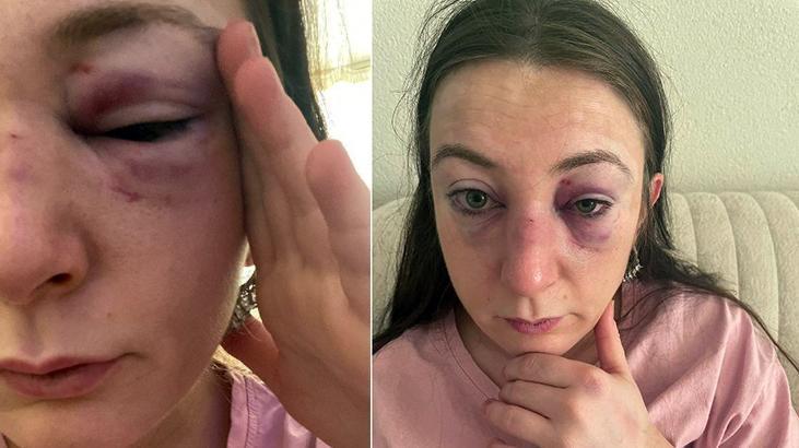 Yüzünü tanınmaz hale getirdi: Her kafa darbesine 1 yıl