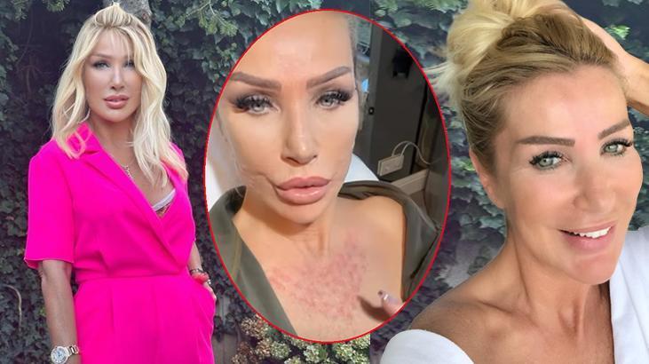 Seda Sayan’dan yeni estetik! Yüzüne ve dekolte bölgesine sünnet derisi enjekte ettirdi