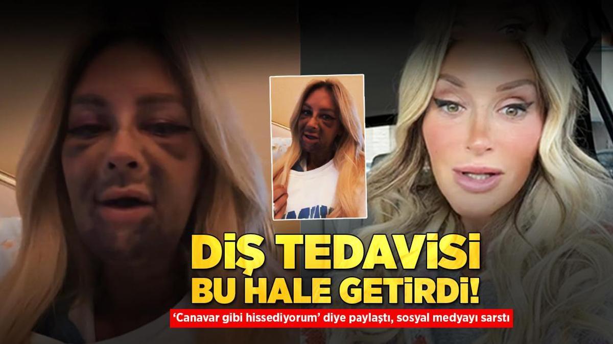 Diş tedavisi bu hale getirdi! ‘Canavar gibi hissediyorum’ diyerek paylaştı, sosyal medyayı sarstı