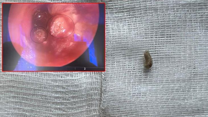 13 yaşındaki çocuğun kulağından 2 kurtçuk çıkarıldı