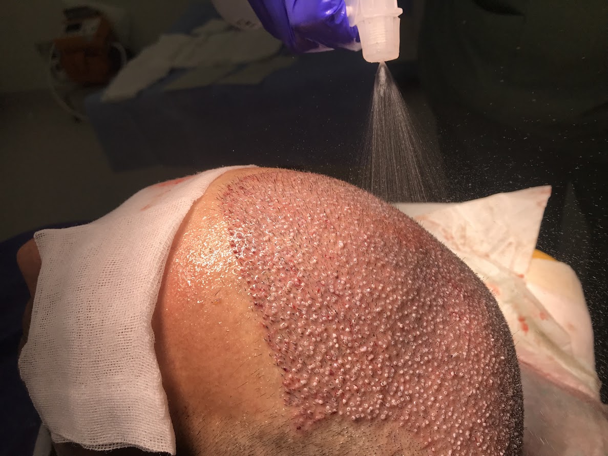 Clinista Saç Ekim Merkezi’nin Profesyonel Saç Ekimi Yaklaşımları