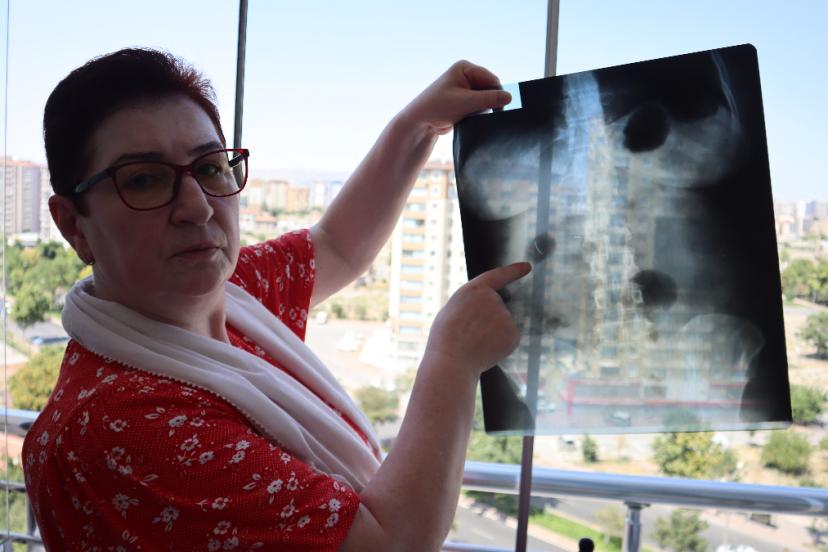 Karnında Unutulan Ameliyat İğnesiyle 22 Yıldır Yaşıyor: Ayhan Tanyıldız’ın Çilesi