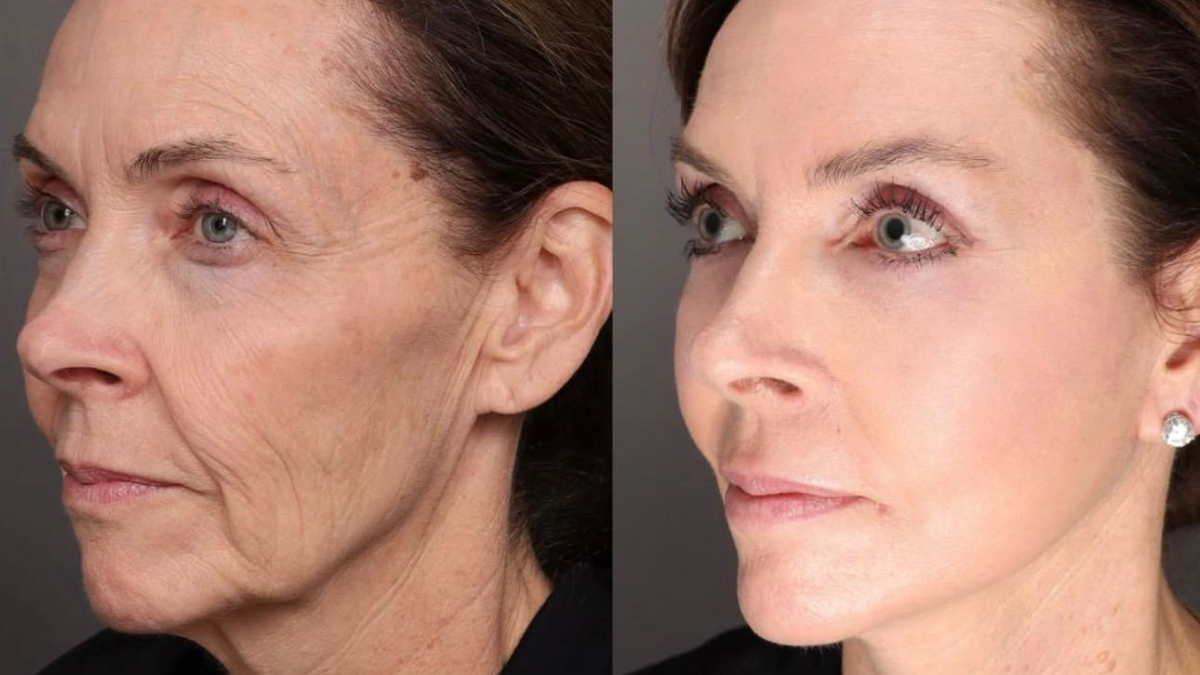 Yüz Germe Operasyonlarında Güven Veren İsim: Op. Dr. Kadir Fırat